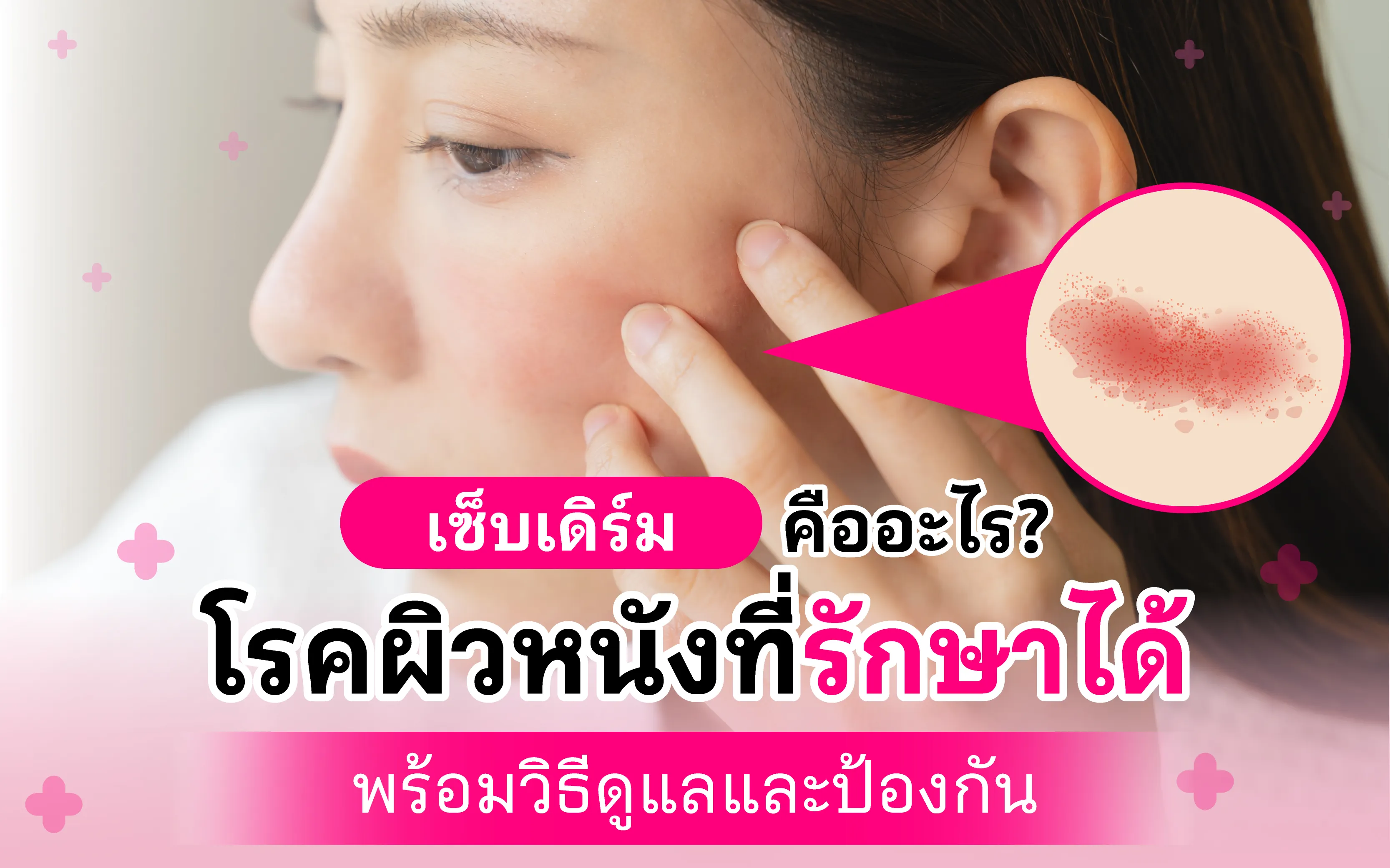 เซ็บเดิร์ม คืออะไร? โรคผิวหนังที่รักษาได้ พร้อมวิธีดูแลและป้องกัน
